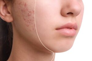 How does glycolic acid treat acne
