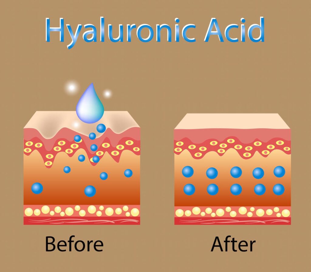 What Does Hyaluronic Acid Do For Acne? Viviane Woodard Skincare