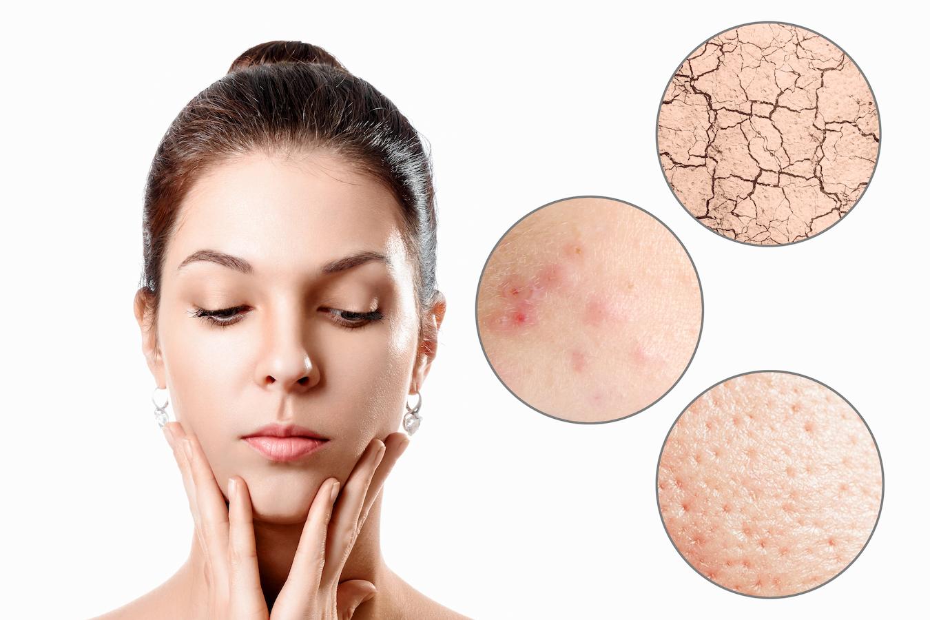 Skin care can prevent us from blemishes acne and aging